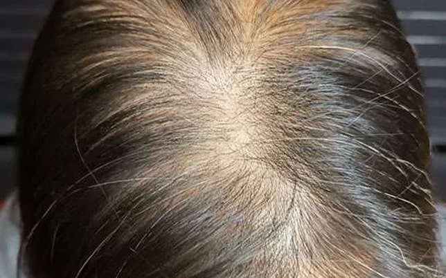 bf_1_1-min katrien voor micro haar pigmentatie