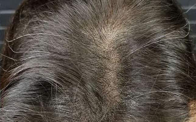 bf_1_2-min katrien na micro haar pigmentatie