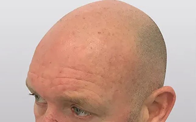 bf_2_1-min jos voor micro haarpigmentatie