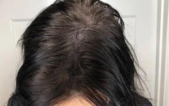 bf_3_2-min Annemie na haar pigmentatie