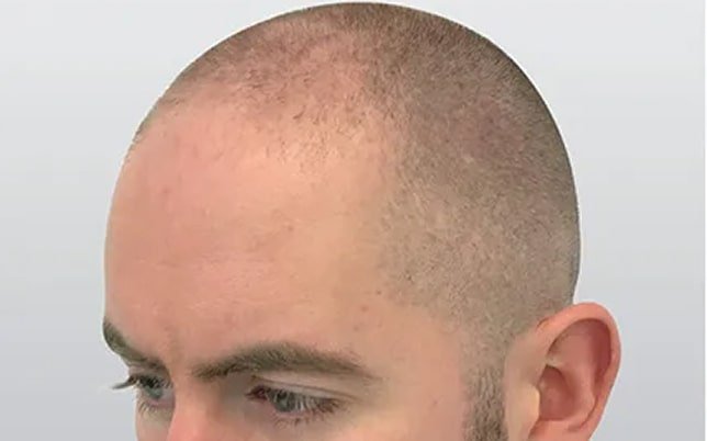 bf_4_1-min Alex haar laten pigmenteren voor haar tattoo