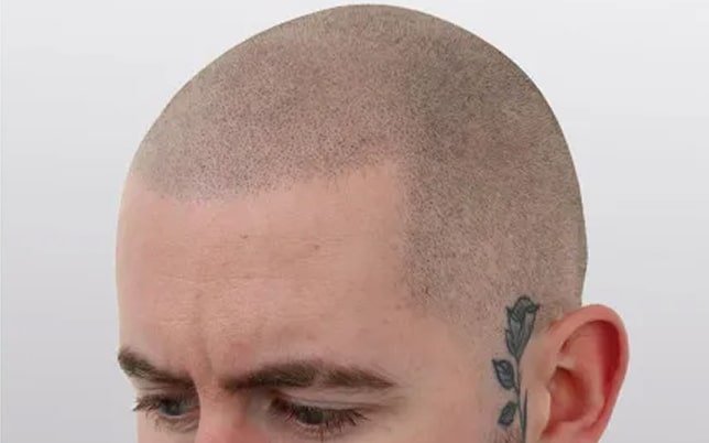 bf_4_2-min Alex haar laten pigmenteren na haar tattoo